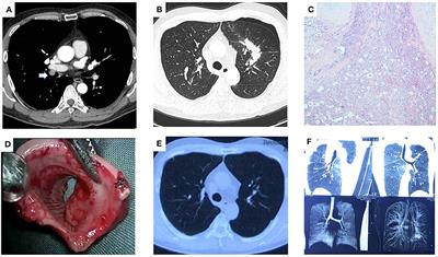 Case Report: Uniportal Video-Assisted Thoracoscopic Parenchymal Sparing Secondary Carinal Resection and Reconstruction for the Treatment of Tracheobronchial Mucoepidermoid Carcinoma